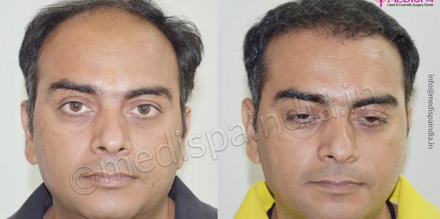 hair transplant in surat gujarat