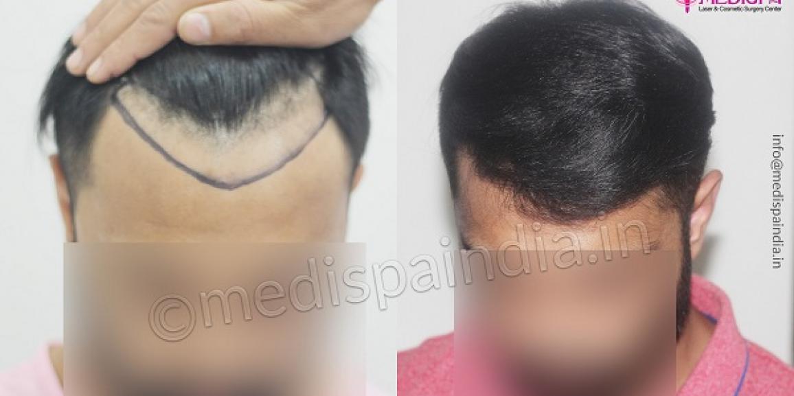 How To Get Natural And Fair Density From Hair Transplant?