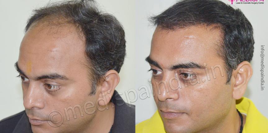 hair transplant surgeons in surat