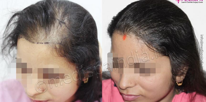 female hair transplant in delhi