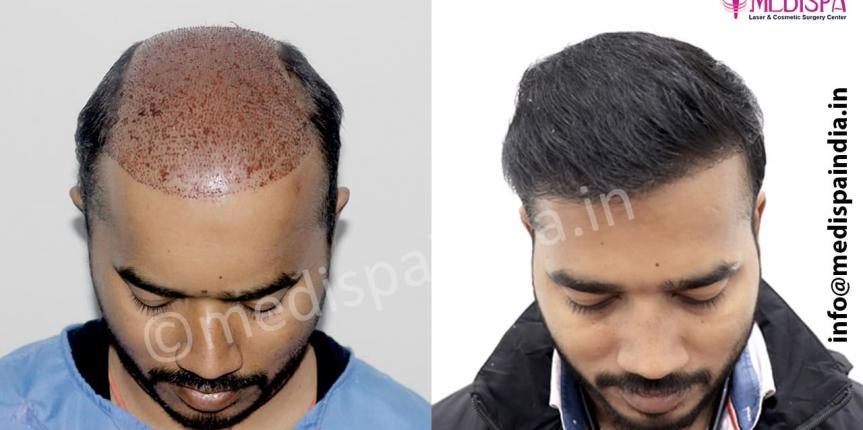 bad hair transplant repair in delhi
