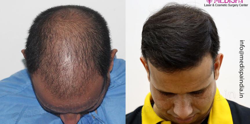 hair transplant india delhi