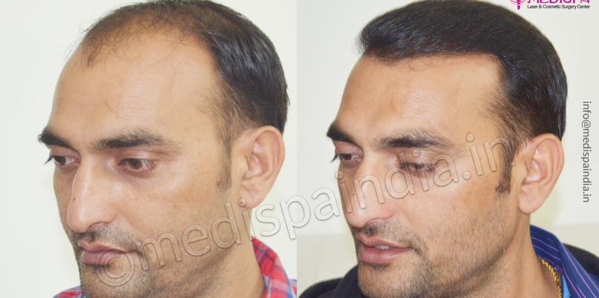 hair transplant cost in bikaner