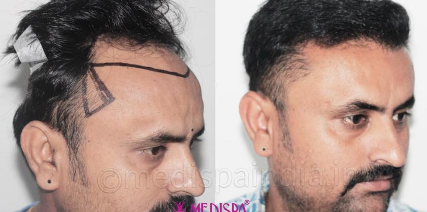 best hair transplant clinic in delhi