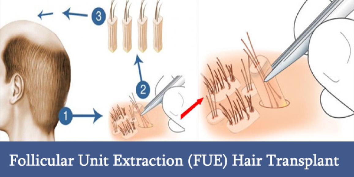 Everything you need to know about FUE