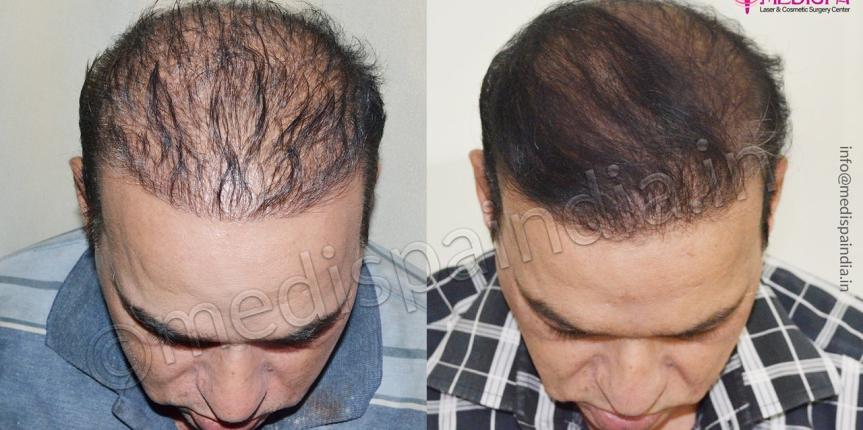 wrong hair transplant correction chennai