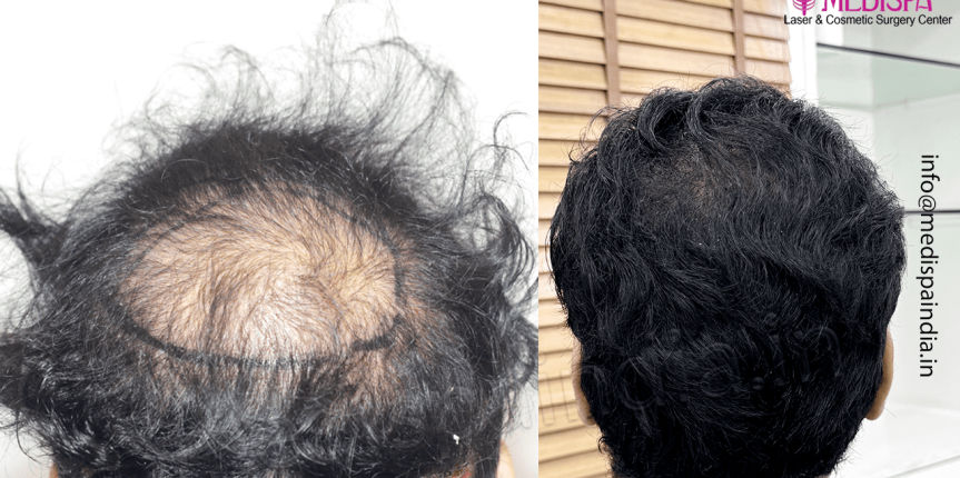 chennai-hair-transplant