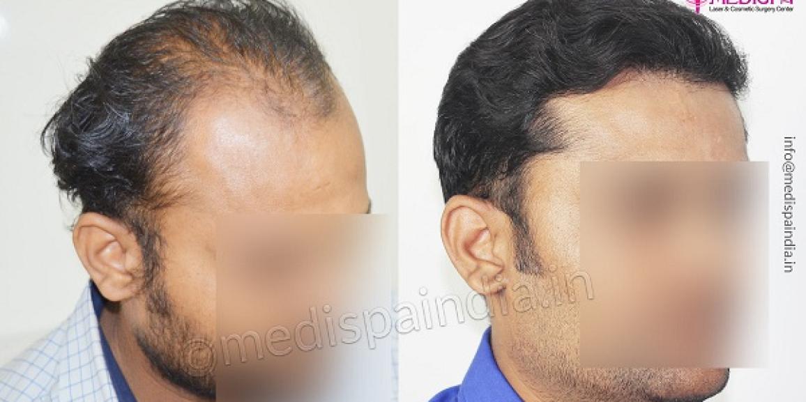 Things To Consider Before Choosing Hair Transplant Clinic in Jaipur