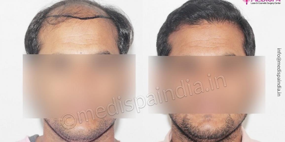 Is Hair Transplant Better Than Medicines?