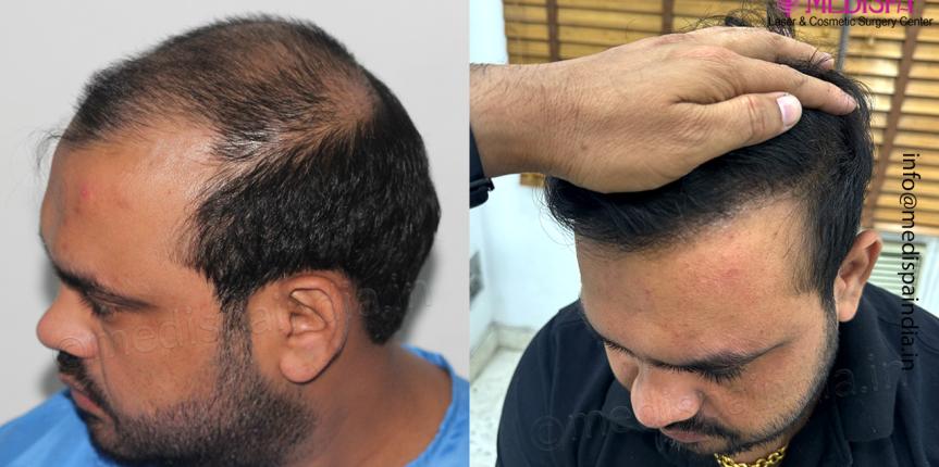 hair restoration gurgaon