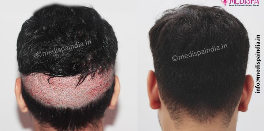 fue hair transplant cost