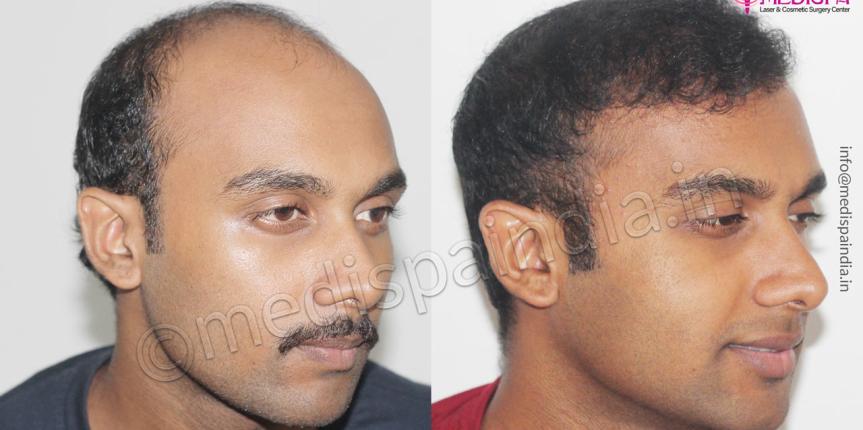 cost hair transplant india