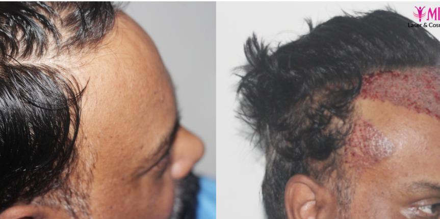 hair restoration clinic results