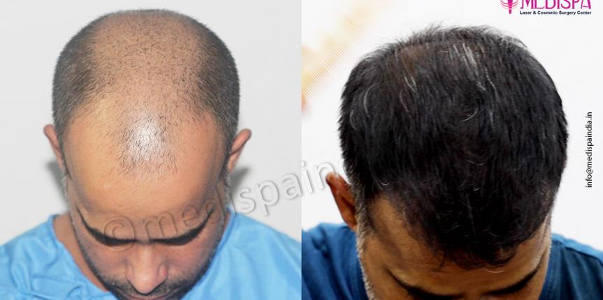 hair restoration result india