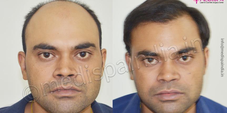 jaipur hair transplant cost