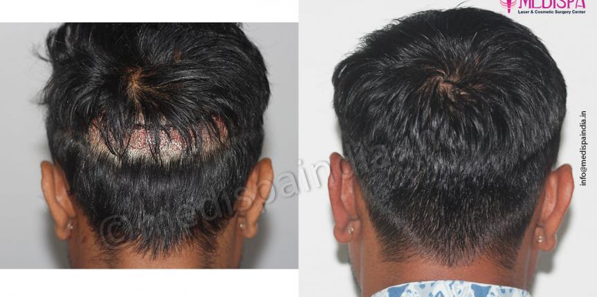 Back Head – Before & After