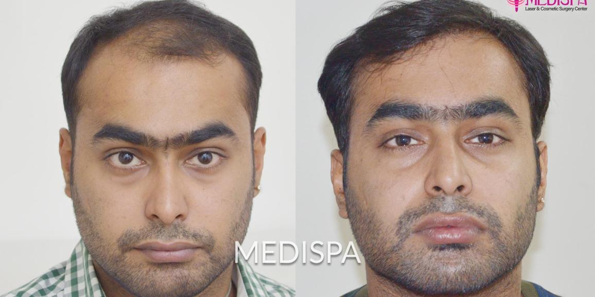 Why Should You Go with the Hair Transplant Procedure