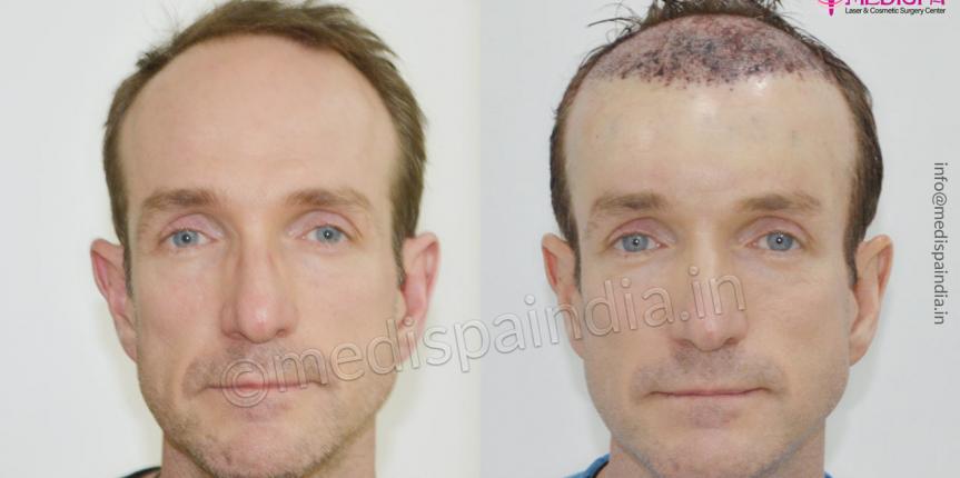 hair transplant australia