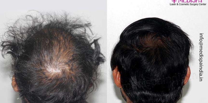 wrong hair transplant repair delhi