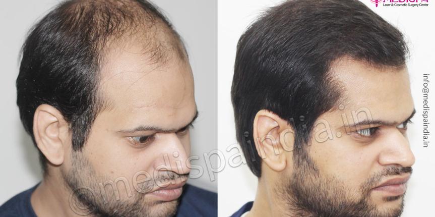 hair transplant clinics in bikaner-rajasthan