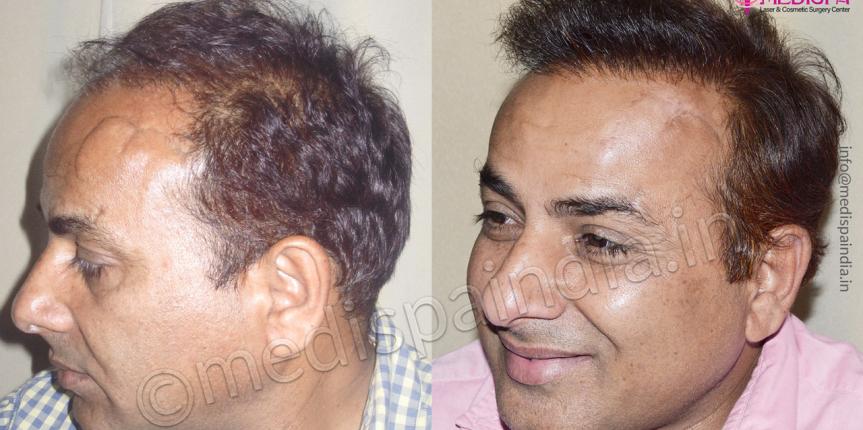 wrong hair transplant results at medispa