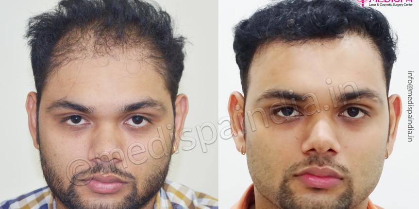 wrong hair transplant correction indore