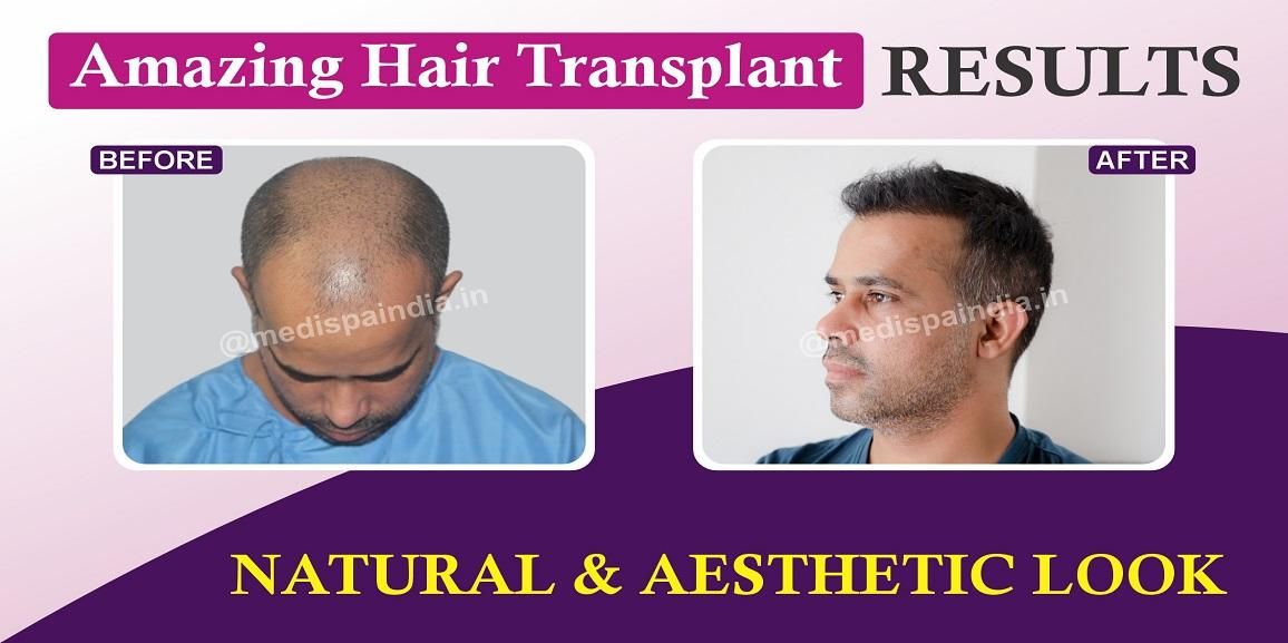 How Can Hair Transplant Help in Achieving Natural Hairline?