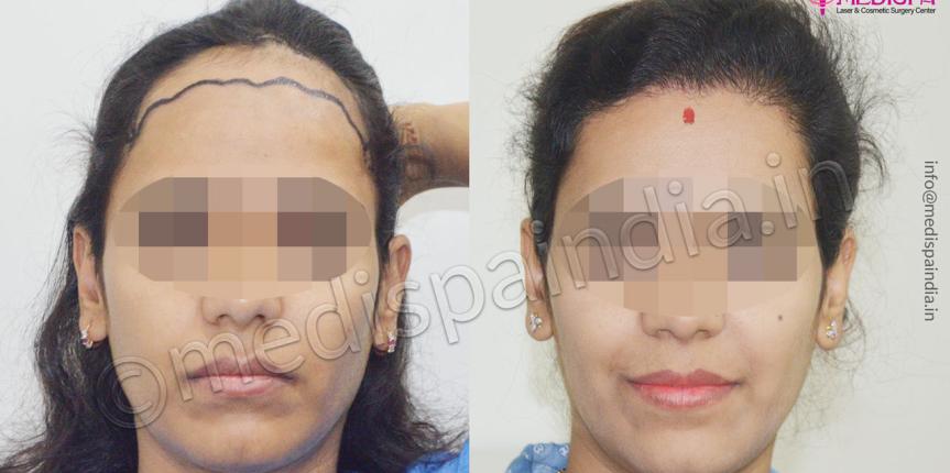 hair transplant in delhi cost