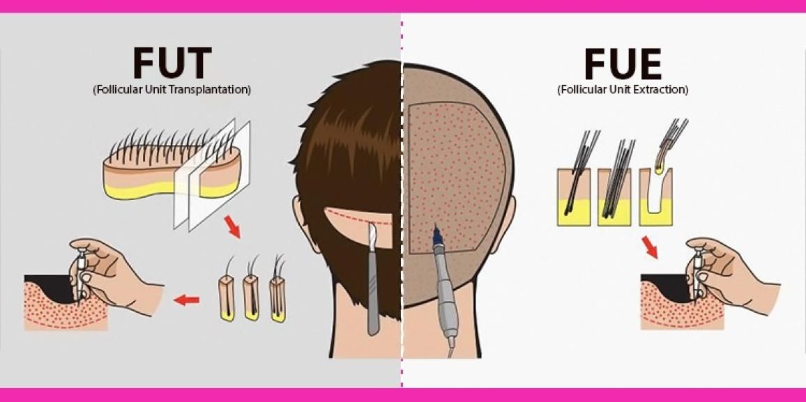 What Are The Dissimilarities Between FUT And FUE Hair Transplant?