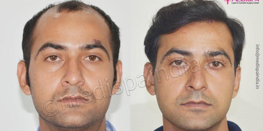 hair transplant clinics in india