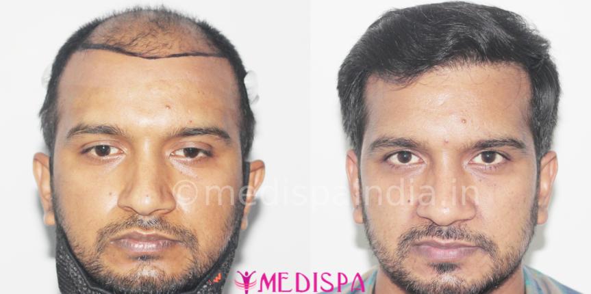 hair transplant price in delhi