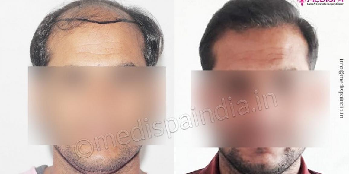 Significant Things To Know Before Undergoing Hair Transplant Surgery