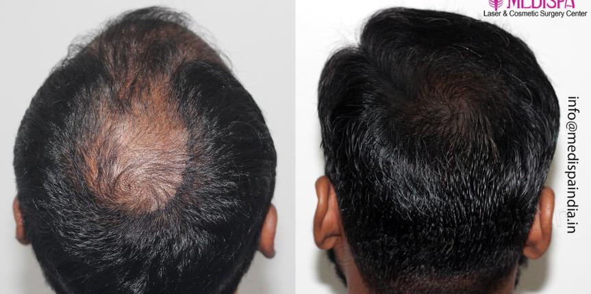 best hair restoration result in hyderabad