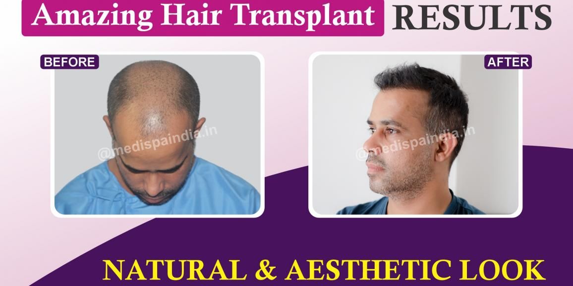 Why Hair Transplant Repair Can Be A Good Idea After A Bad Hair Transplant?