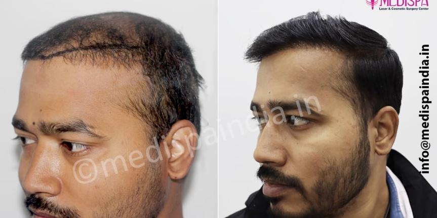 hair transplant repair in india