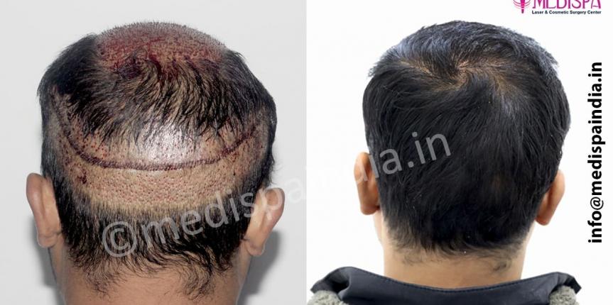 wrong hair transplant repair in jaipur, india