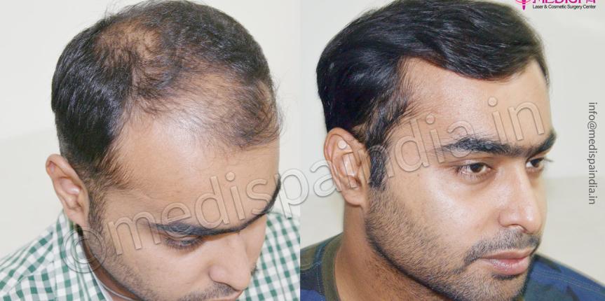 hair transplant clinics in indore