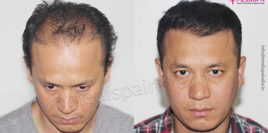 hair transplant results