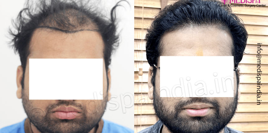 jaipur-hair-transplant
