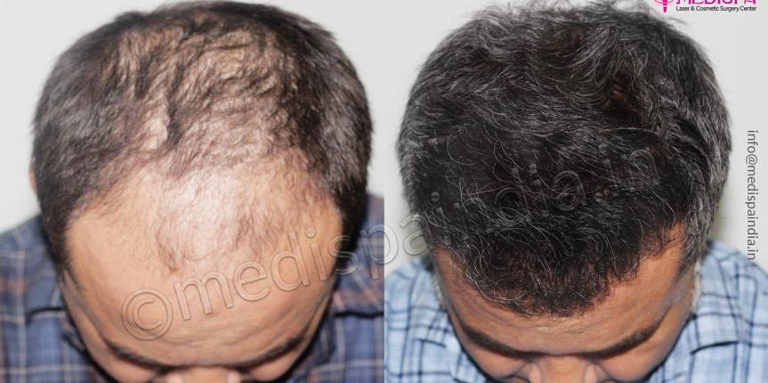 hair transplant saudi arab results