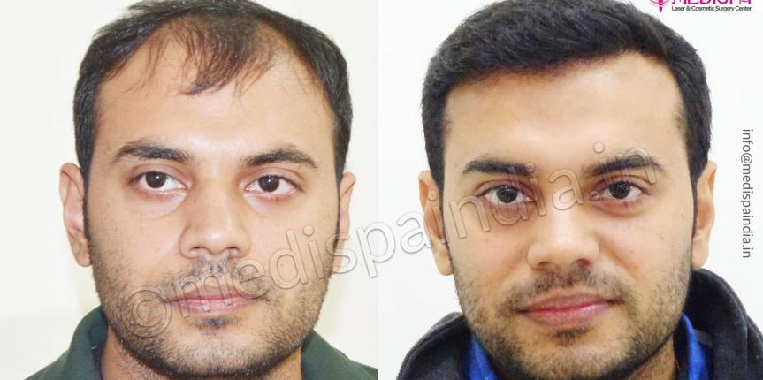 hair transplant clinics in delhi