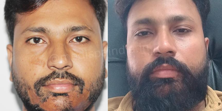 beard hair transplant india