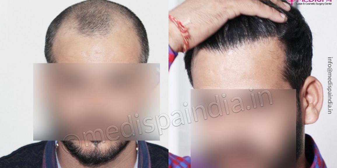 Is Hair Restoration The Best Treatment For Pattern Baldness?