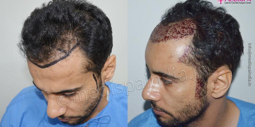 hair transplant result dubai