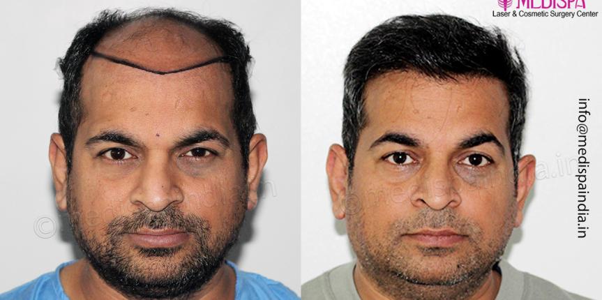best hair transplant cost results bangalore