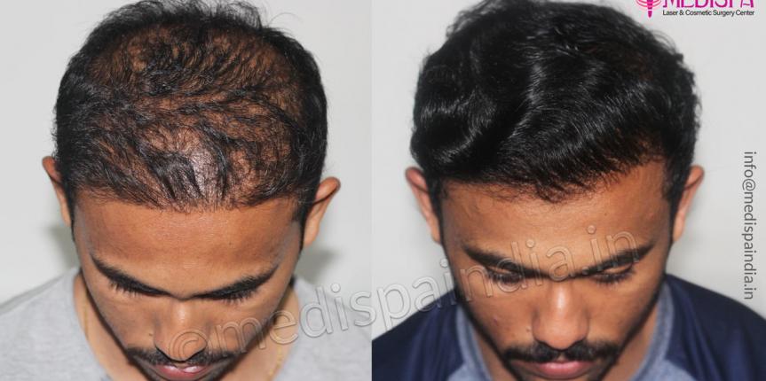 wrong hair transplant before after india
