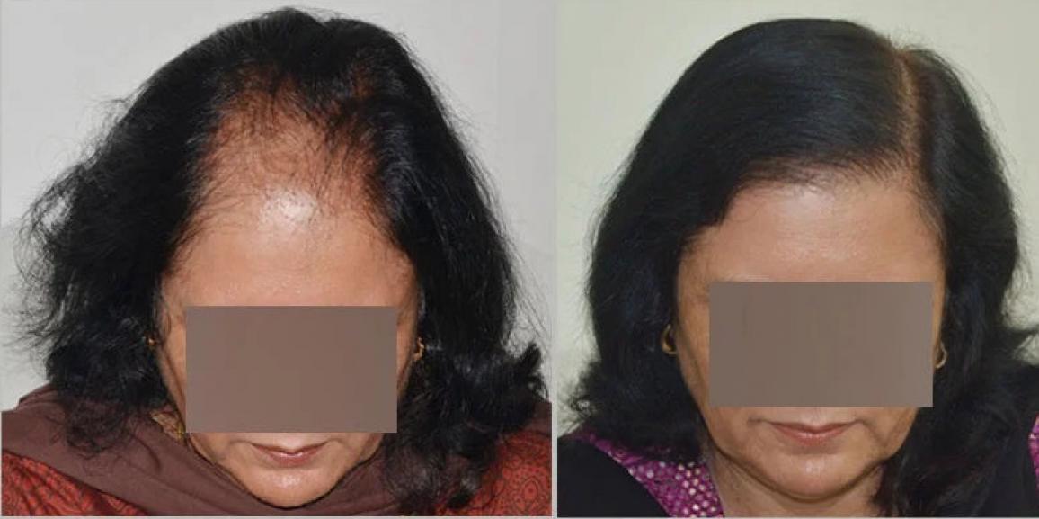 Explain The Important Facts Related With Female Hair Transplant