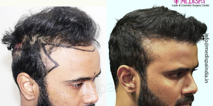 hair transplant delhi results