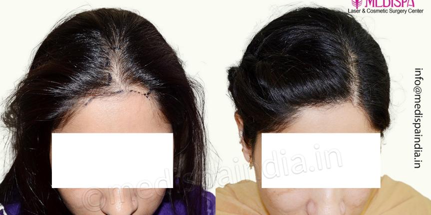 female hair transplant delhi