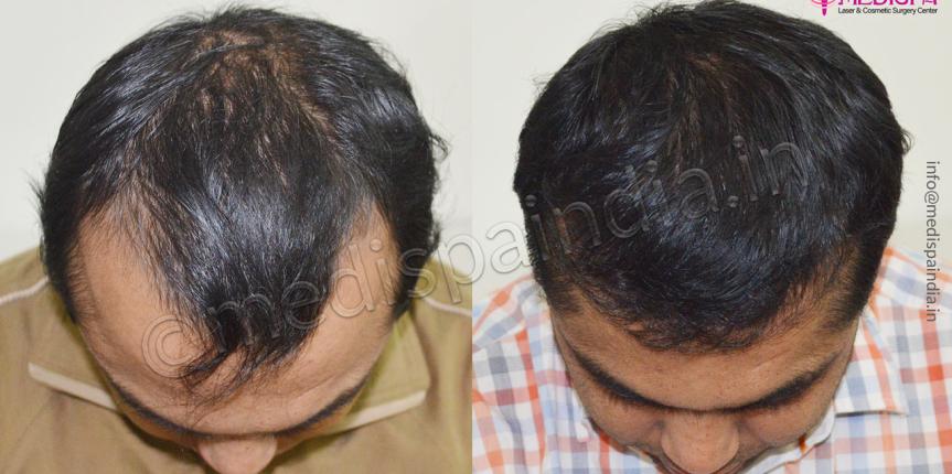 london hair transplant cost